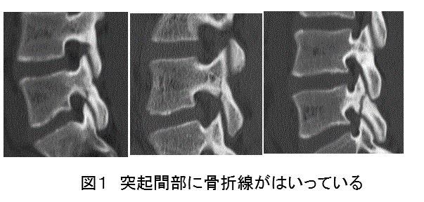 成長期の腰椎分離症 医療法人南谷継風会 南谷クリニック